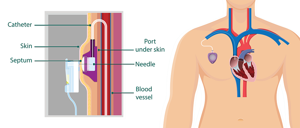 Vascular Access with Port Systems