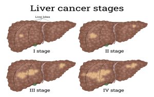 The Different Stages of Liver Cancer | USA Oncology Centers